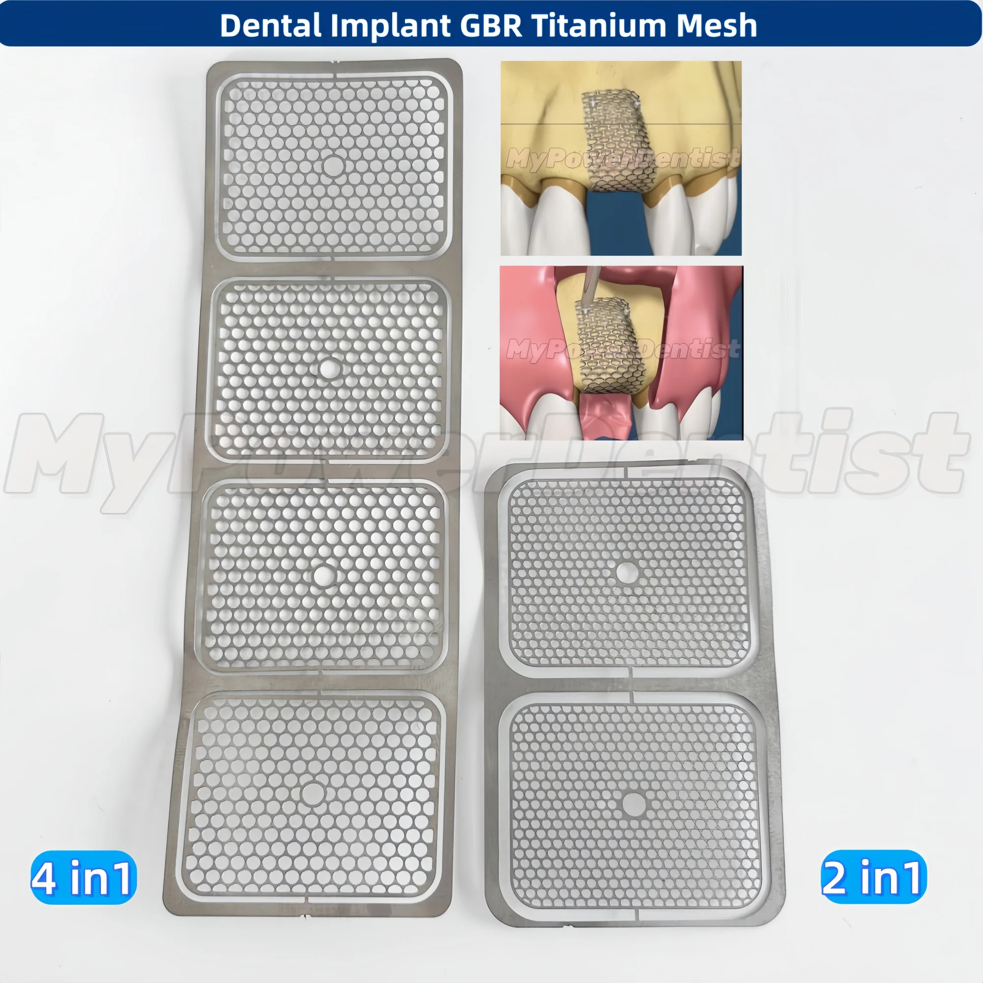

10Pcs Dental GBR Titanium Mesh Bone Regeneration Titanium Film Implant Mesh 2 in 1/4 in 1