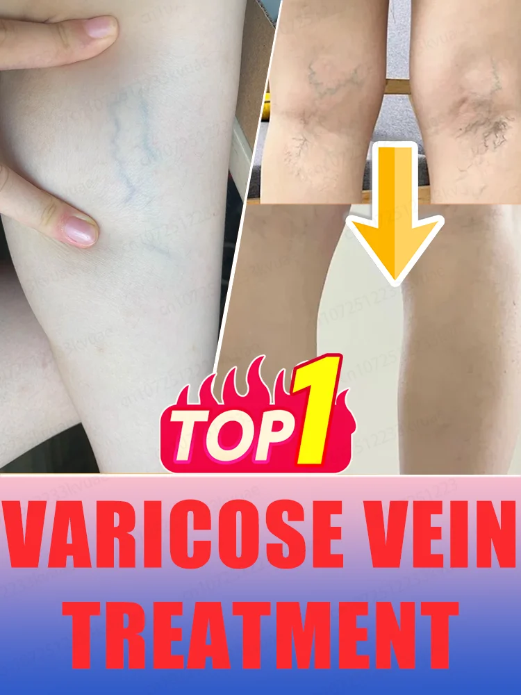 

blue light pen solve varicose veins, hot sale leg care tools