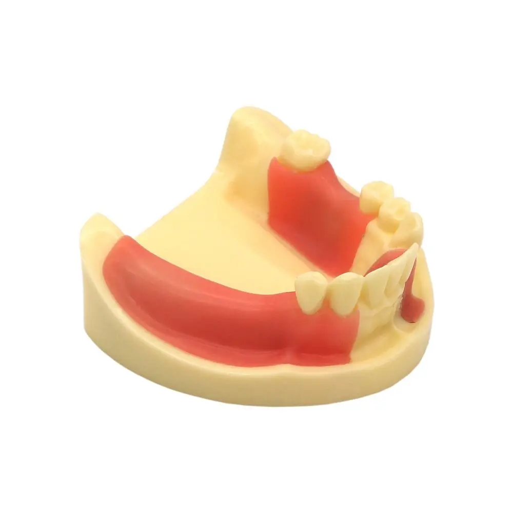 Dental Teeth Model Lower Jaw Removable Gingiva Implant Teeth Practice Demo Typodont Teeth Model M2004