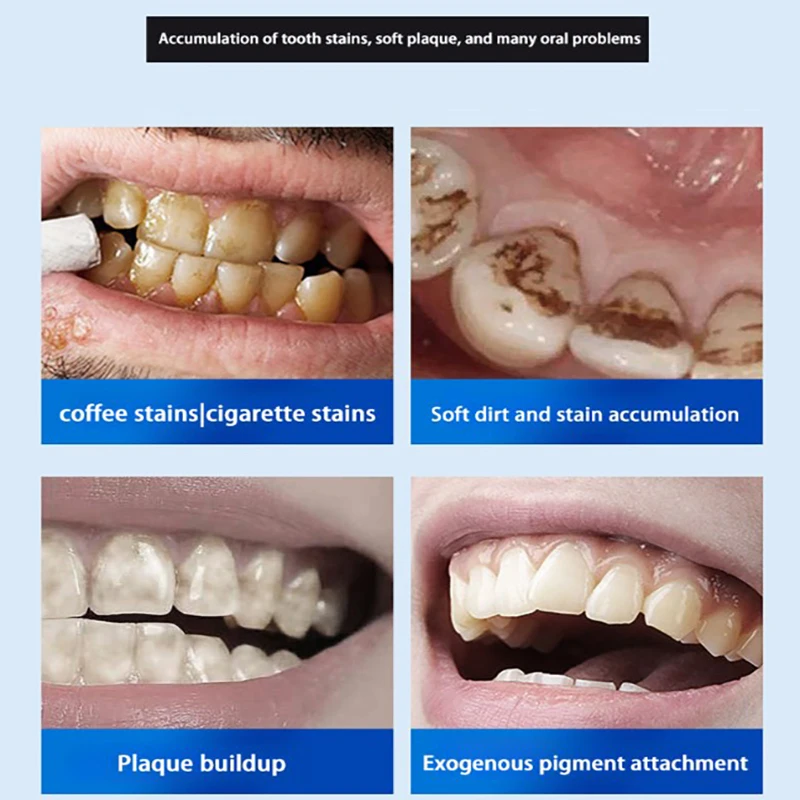 Enzima probiótica para blanquear la pasta de dientes, refresca el aliento, Reduce las bacterias orales, previene la Periodontitis, pasta de dientes de fluoruro