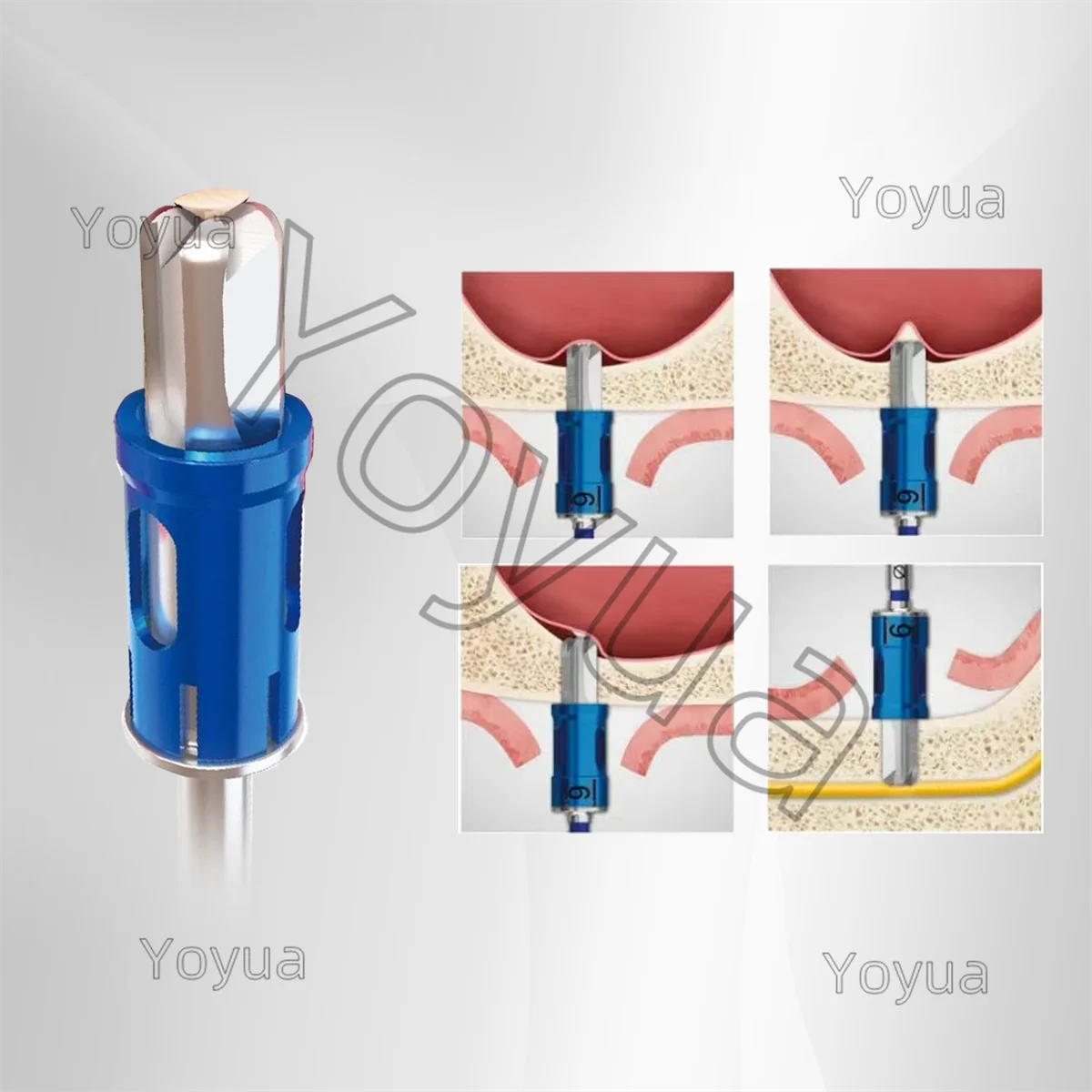1 مجموعة زراعة الأسنان الفكري الجيوب الأنفية رفع أداة صندوق كريستال نهج الجيوب الأنفية عدة طبيب الأسنان زرع الأدوات الجراحية أدوات #4