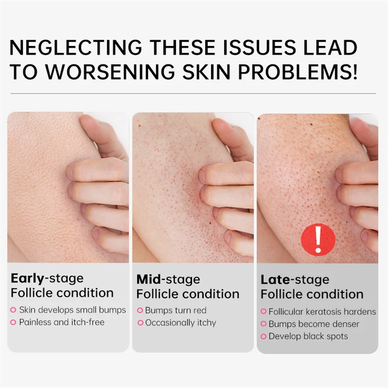 50g Keratosis Pilaris Repair Cream Chicken Follicle Skin Remove Body Dark Spot Smooth Body Lotion Moisturiz Whitening Dull Skin