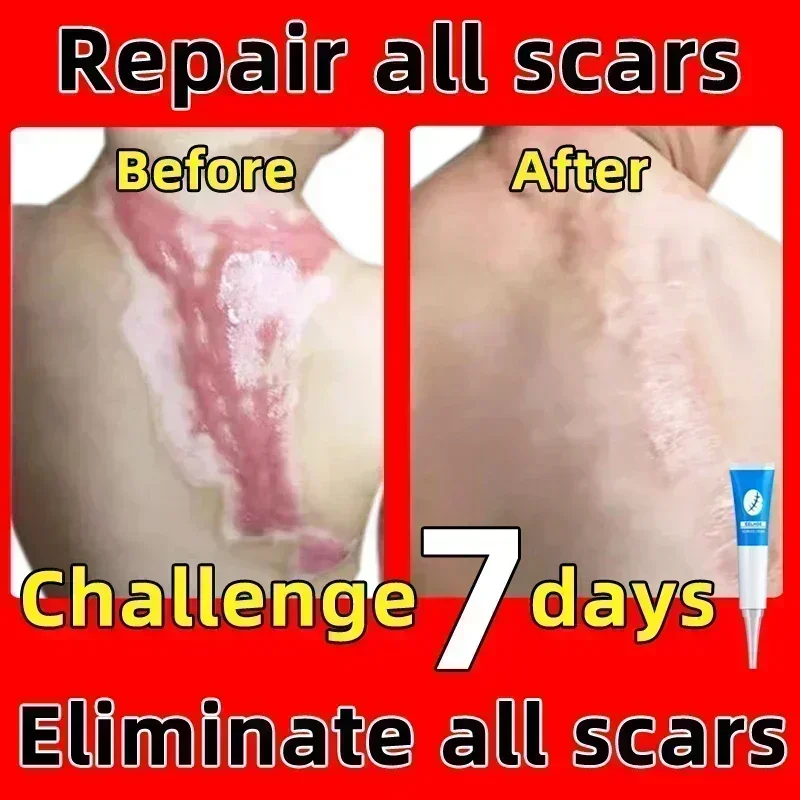 حفر حب الشباب علامات التمدد ، إزالة الندبات القديمة ، الإصلاح الفعال ، الجراحة ، Scars090