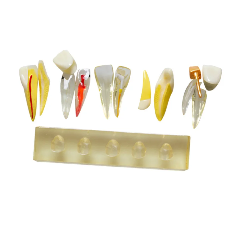 Removable anterior dental pulp pathology model, detachable dental particles for medical students to practice and demonstrate