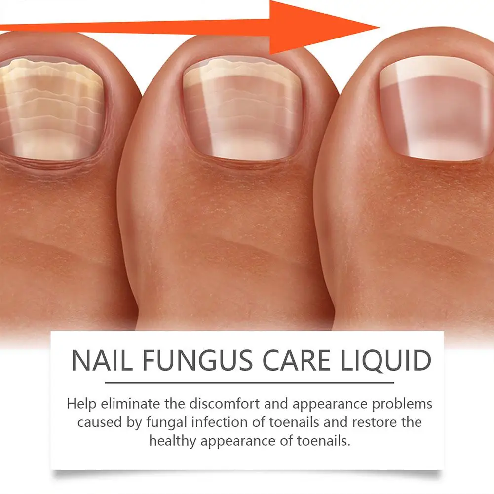 Tratamiento de uñas fungicida, aceite para eliminar hongos en los pies, Gel para los dedos de los pies, antiinfección, 50g, R8D2