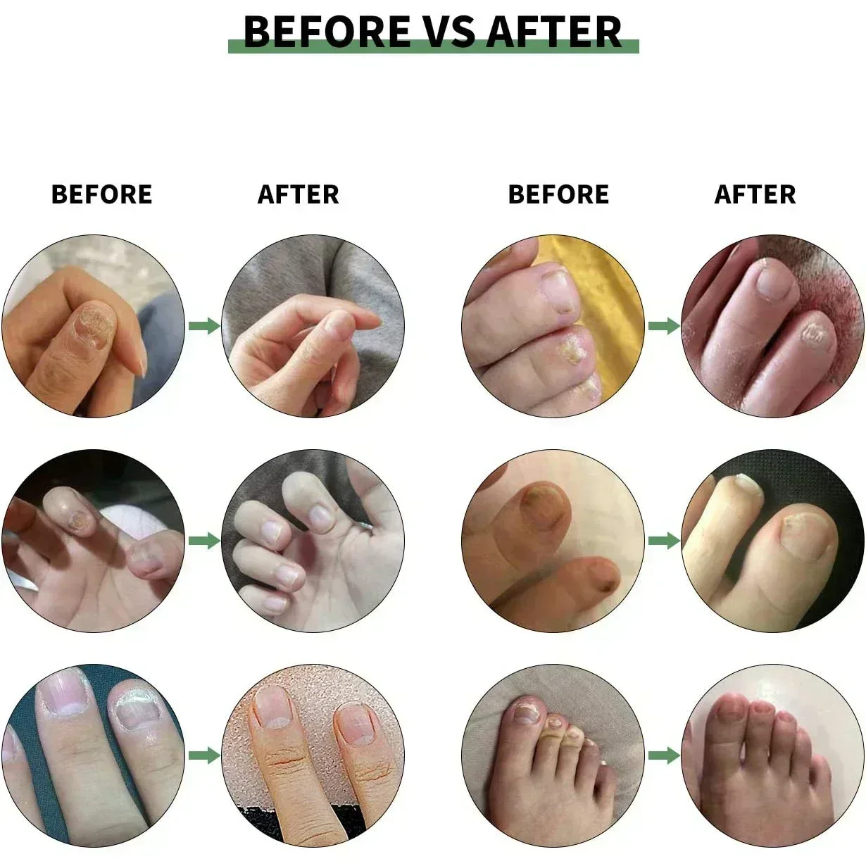 Tratamento de fungos nas unhas soro onicomicose paroníquia anti infecção fungo do dedo do pé mão pé remoção reparação gel cuidados beleza saúde