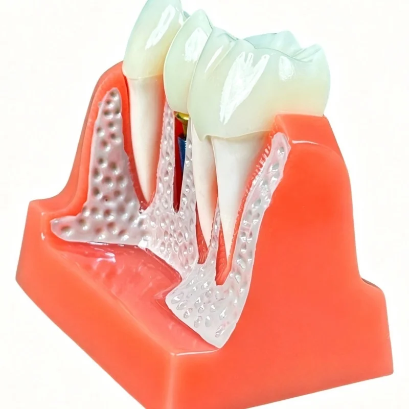Dentistry Implant Model 4 Times Teeth Caries Comparsion Study Denture Models Analysis Crown Bridge Porcelain Restoration Study