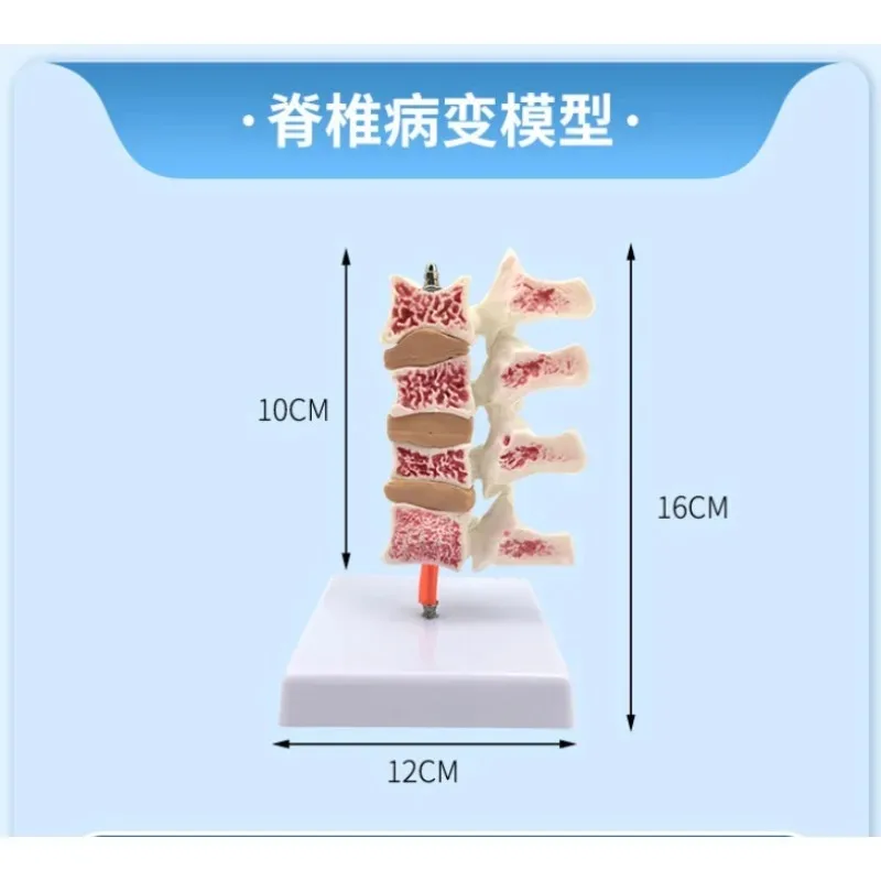 Human anatomical spine Bone vegetable pine Medical skeleton model Spinal typical lesion