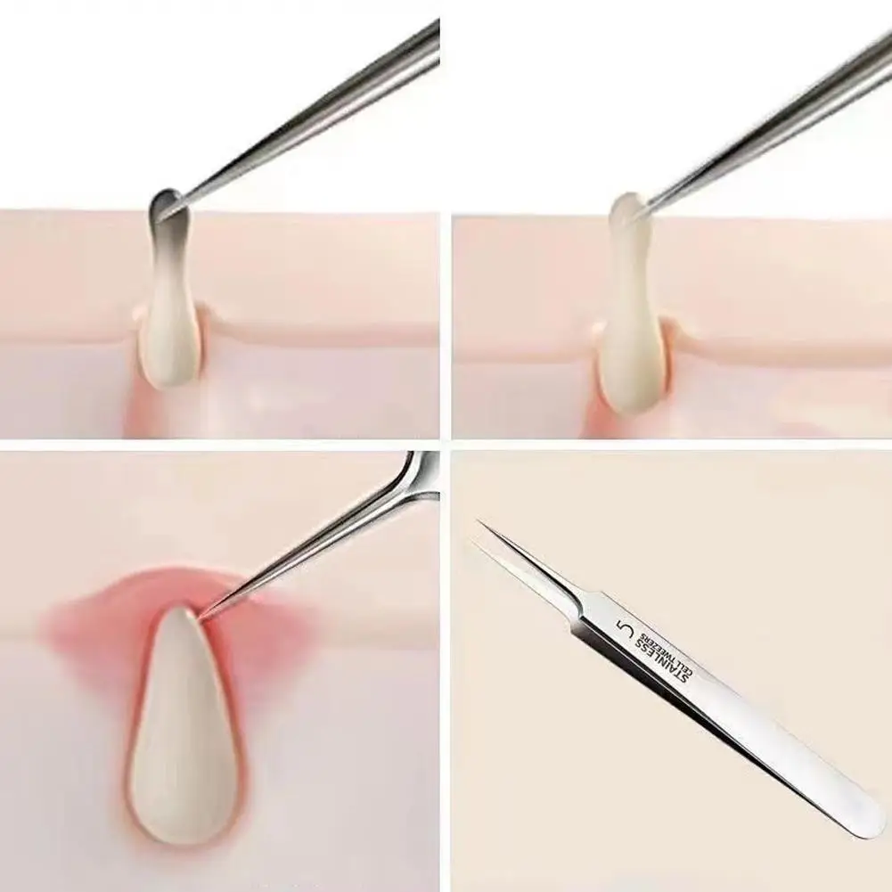 5/8 Uds. Removedor de espinillas y espinillas, pinzas ultrafinas, Extractor de puntos negros, aguja para acné, limpiador Facial, cuidado de la piel