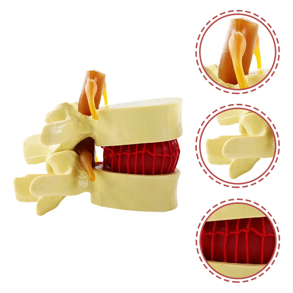 Intervertebral Disc Model Lumbar Spine for Teaching Models Human Herniation Demonstrating Vertebrae Degenerative Learning Body