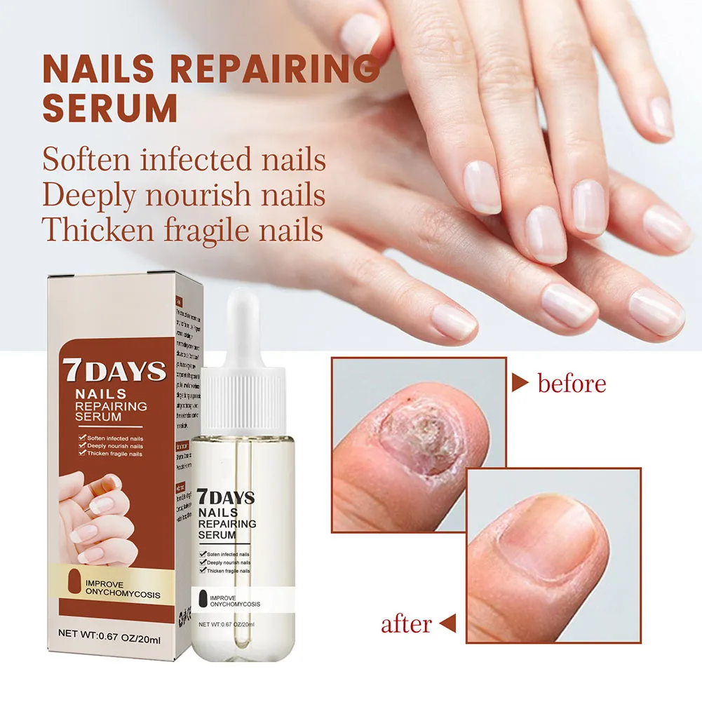 20ml Nail Growth And Strength Serum Professional Nail Strengthening Treat Liquid For Finger Toe Nail