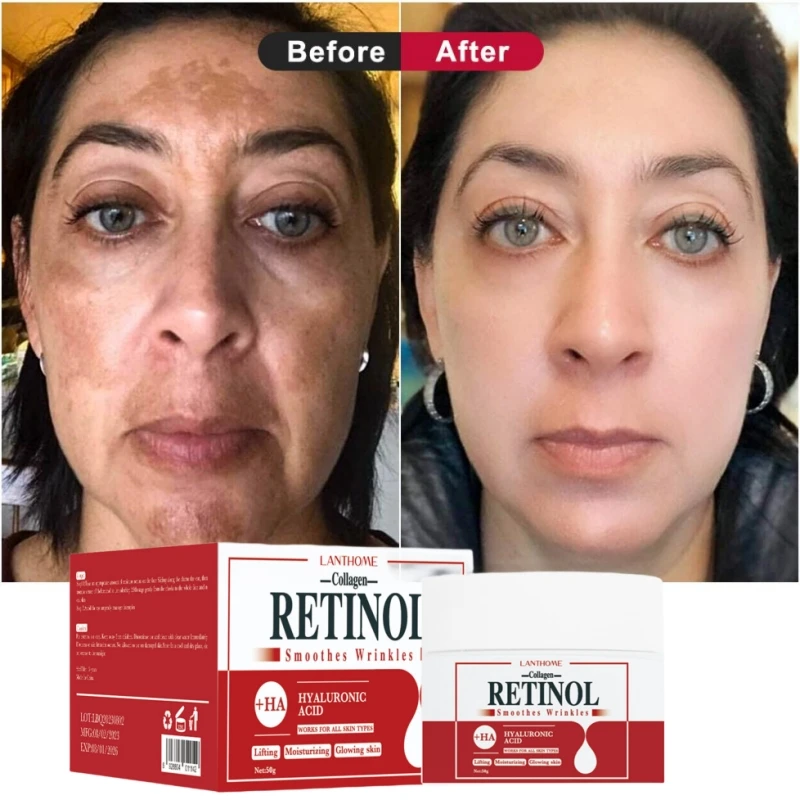 Whitening Freckles Cream Retinol Face Dark Spots Remover Repair Products Removal Melasma Melanin Moisturizing Brighten Skin Care