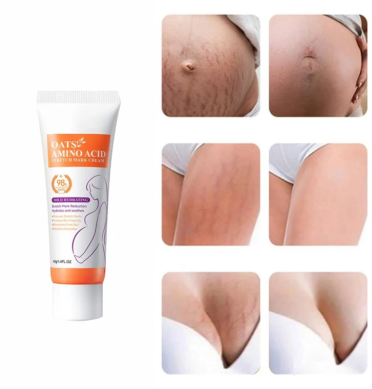 Pregnancy Stretch Marks Removal Effective Treatment Eliminate Red White Old Surgical Marks Oil