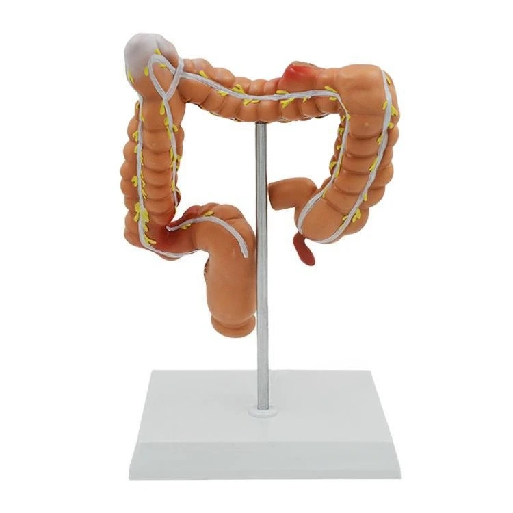 Human colon disease model, anorectal department, digestive department, large intestine model