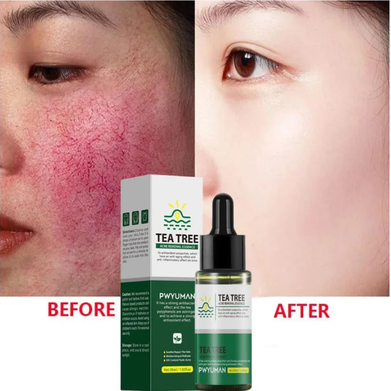 Facial Redness Repair Serum Against Redness Rosacea Spider Vein Treatment Sensitive Skin Shrink Pore Korean Face Skin Care Cream