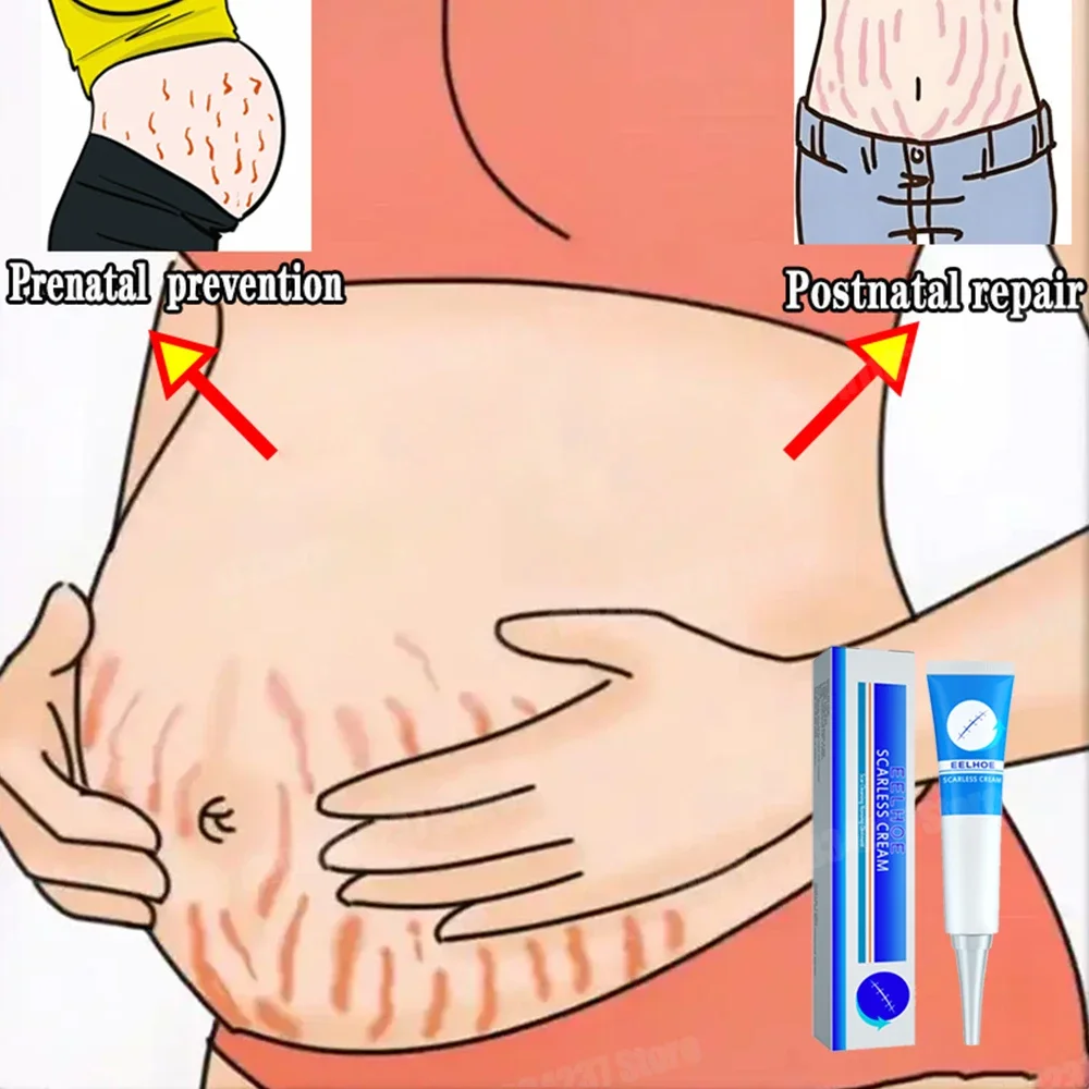 

Nourishing Stretch Marks Cream Eliminate Red White Marks Skin Firming Pregnancy Postpartum Care
