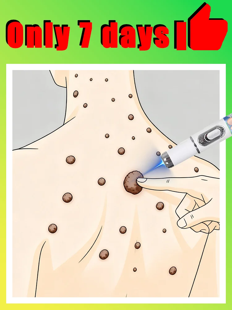 الجمال، قلم الضوء الأزرق يحل الثآليل، غير مؤلم، شحن مجاني، أدوات العناية بالثآليل الساخنة، بسرعة