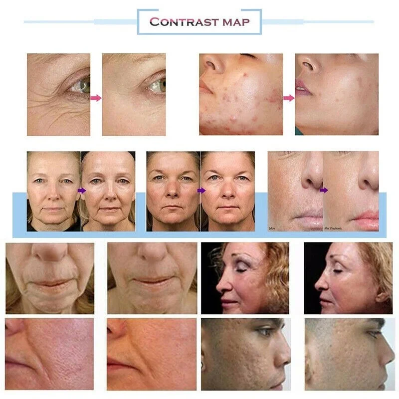 2026 New system Facial professional machine