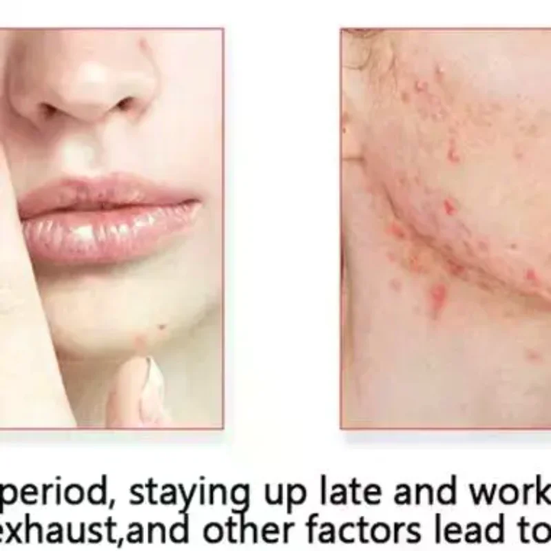 200 pz/set Colore Misto Del Fumetto Adesivi Per L'acne A Forma di Stella A Forma di Cuore Adesivi Circolari Cura Della Pelle E Strumenti di Trucco Viso