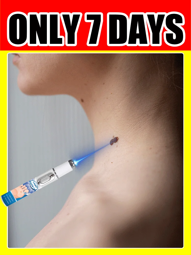 في 7 أيام الجيل - 2 ليزر يقول وداعاً لجميع الثآليل