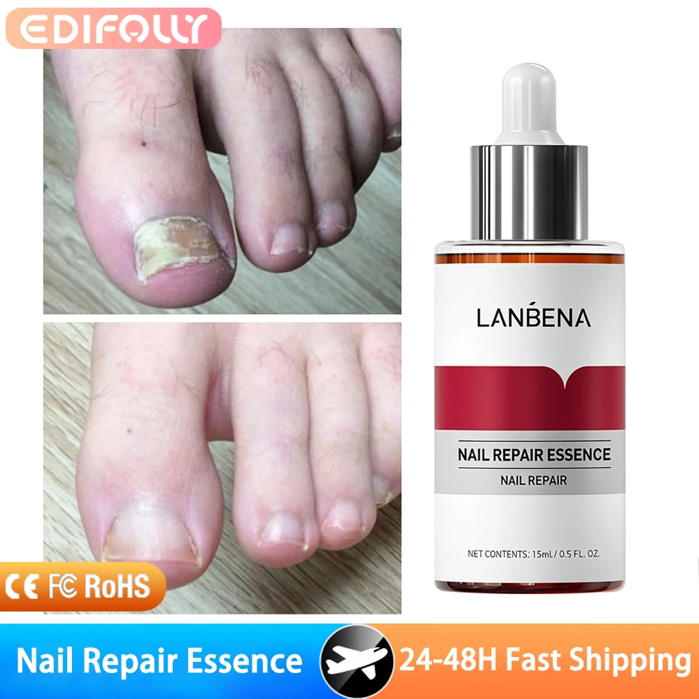 15 مللي مصل إصلاح الأظافر علاج الأظافر إزالة فطار الأظافر الفطري تو سطع مغذي اليد القدم العناية بالبشرة