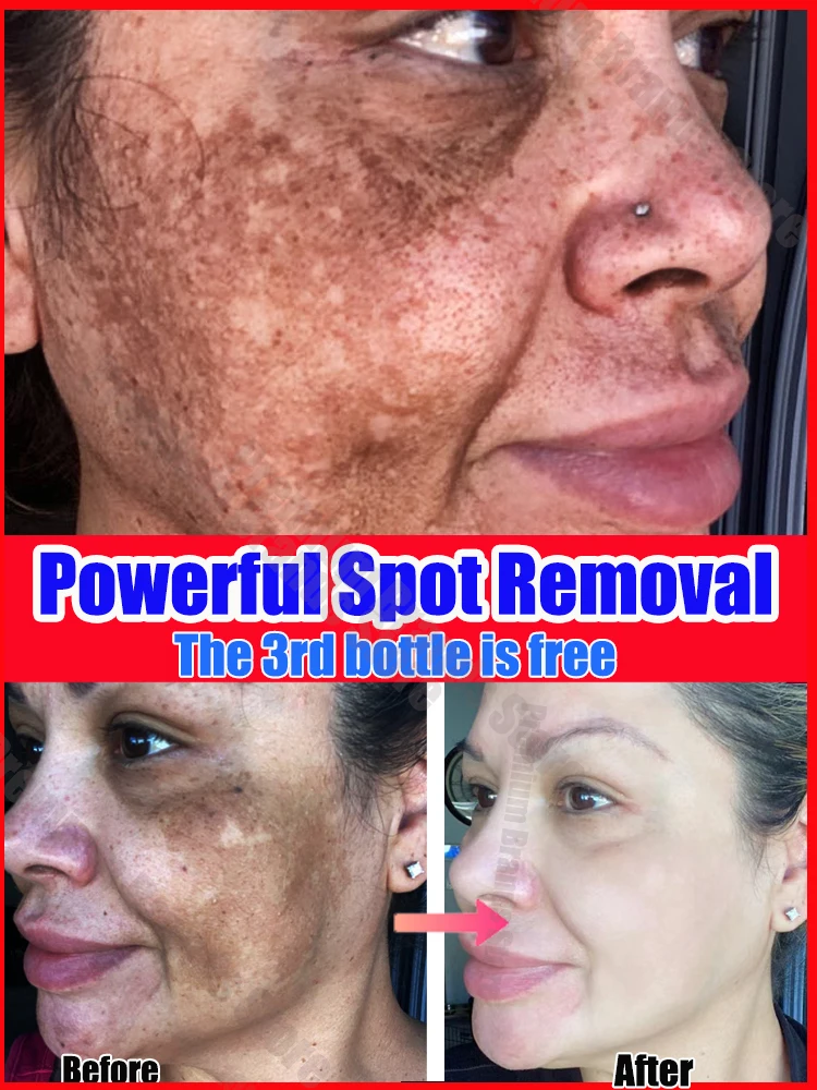 Eliminate facial blemishes