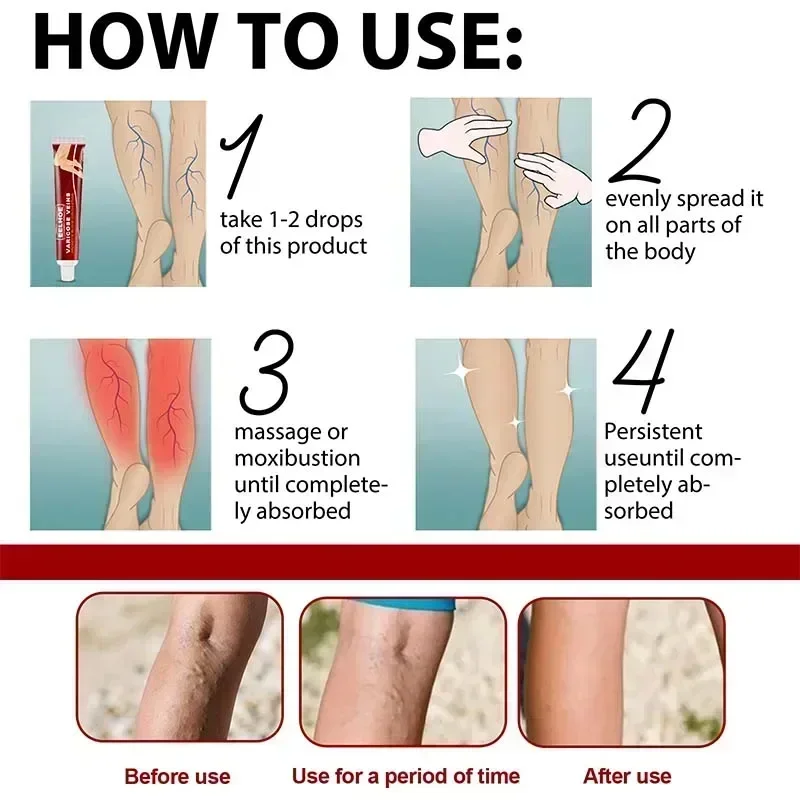 

New Varicose Veins Treatment Cream Spider Vein Treatment Cream Spider Leg Repair