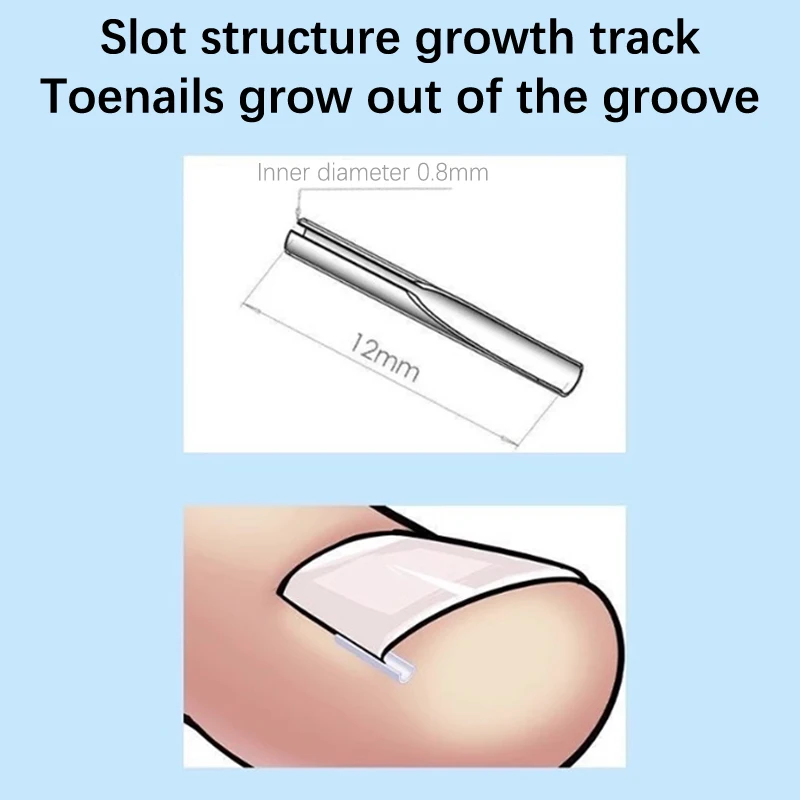 أداة تصحيح أظافر القدم ، وسادة ملء الأظافر ، علاج أظافر أصابع القدم ، رقعة مرنة ، مشبك تقويم ، أداة العناية بالأقدام