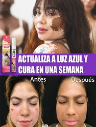 Vitiligo Laser manchas brancas