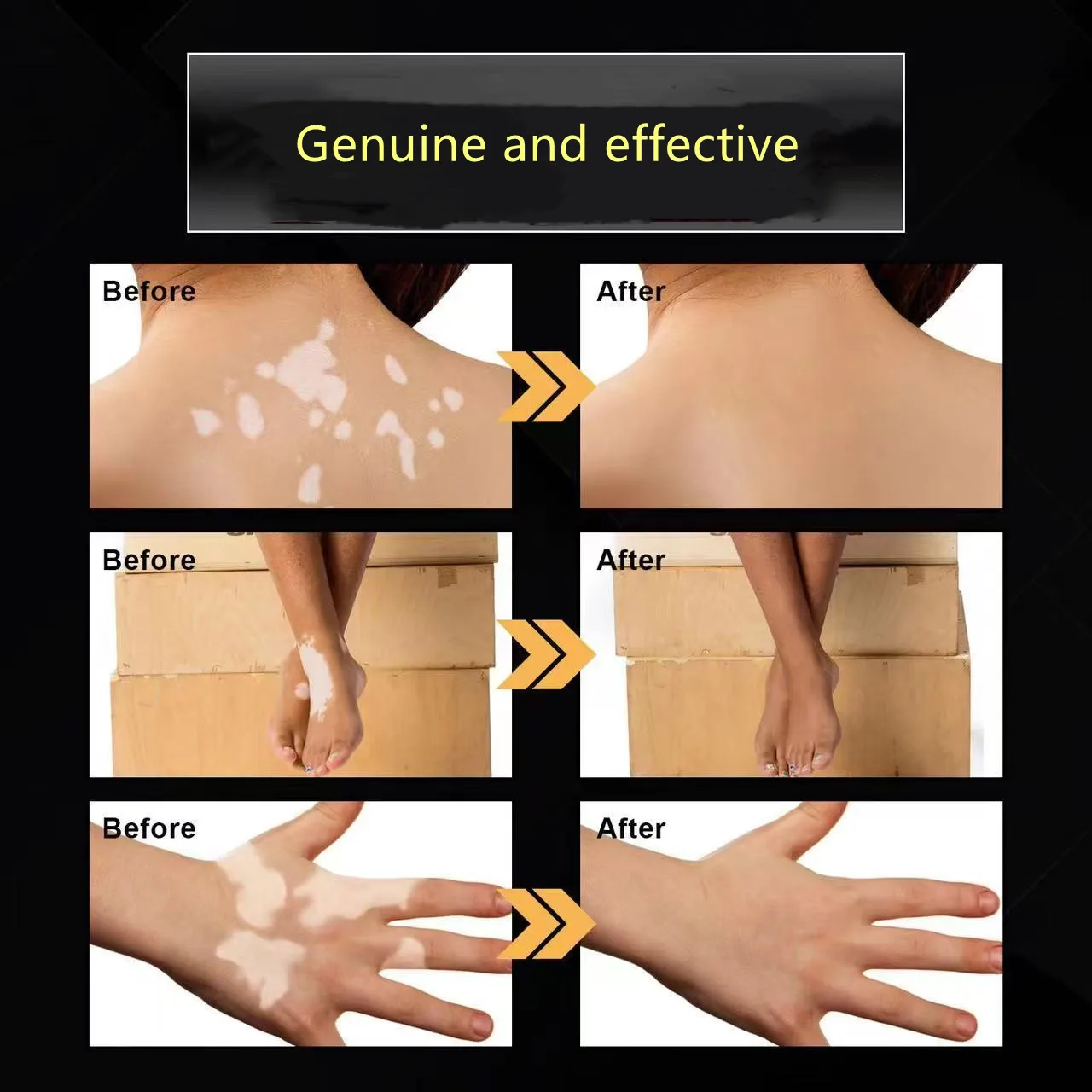 Orginal Whitening Skin Cream Vitiligo Bleaching Creame Face Body Dark Spots Remover Melanin Removal Brightening Decolorizing