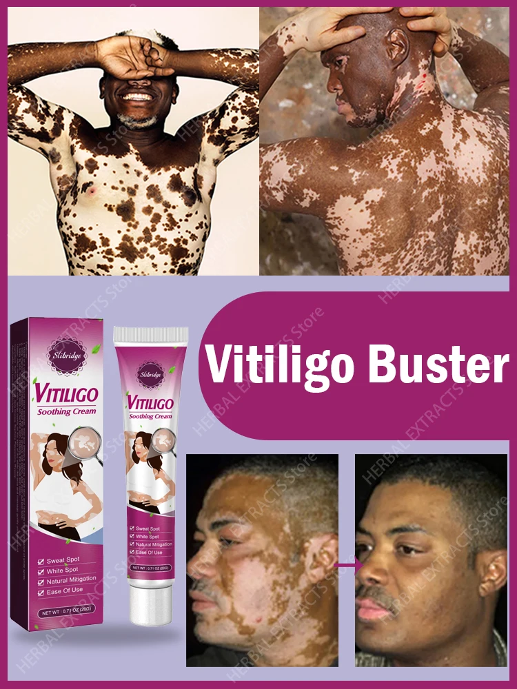 Creme para vitiligo melhora manchas brancas