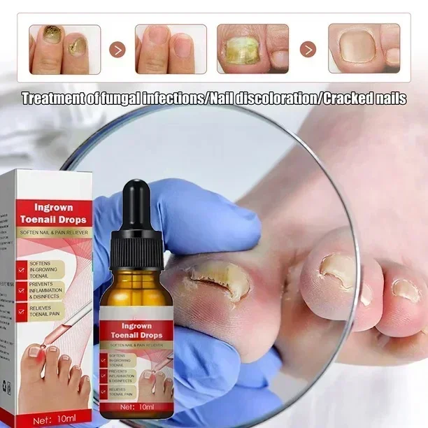 HOT SALE Extra Strong Nail Fungus Feet Nails Repair Care Anti Infection Toe Fungal Removal