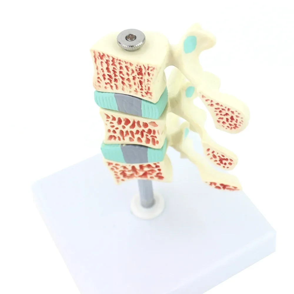 3D Osteoporosis Model with Spinal Column and Skeletal System for Medical Science Teaching and Research