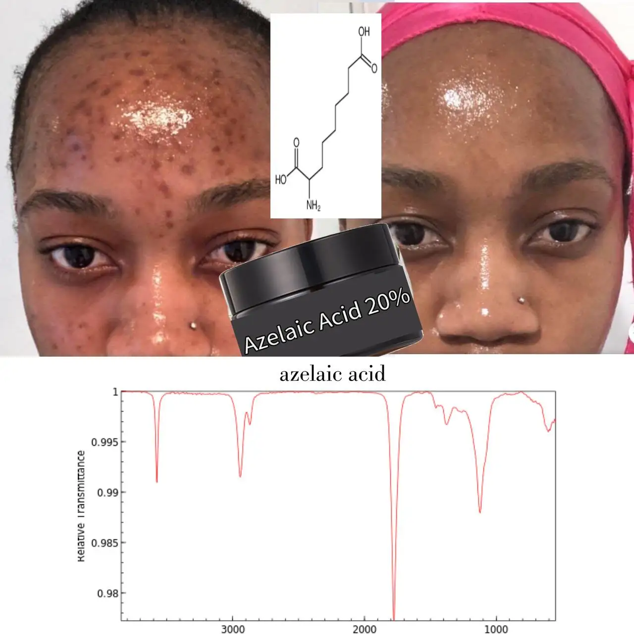 Azelaic Acid 20% לבריאות העור – סרום מומלץ לבריאות העור ותהליך השחיה