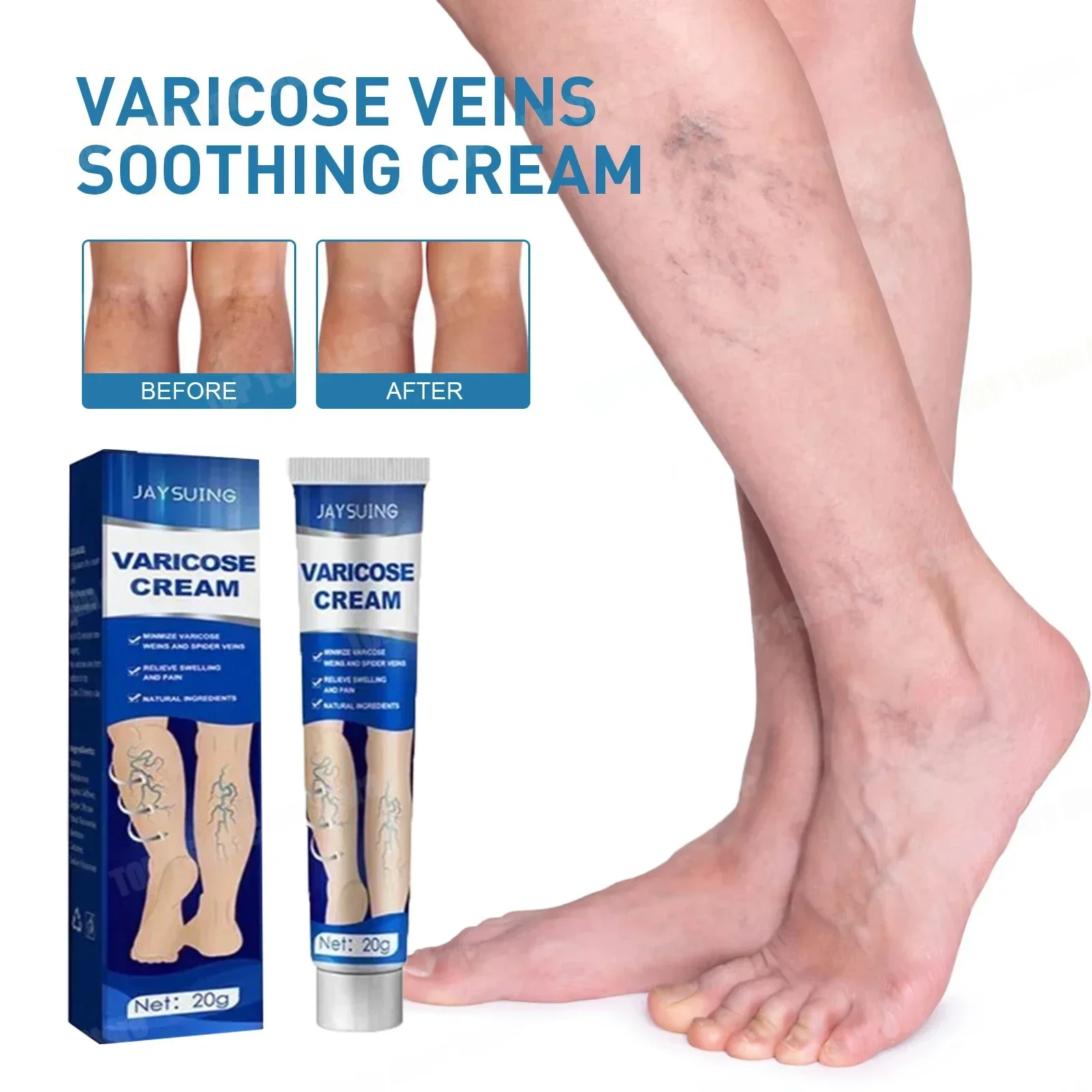 Varicose veins effectively alleviate lower limb vasculitis and improve circulation in patients with venous inflammation