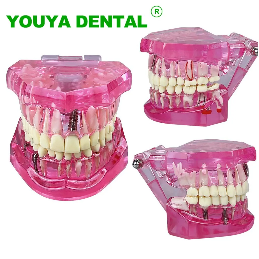 Dental Model Teeth Implant Restoration Bridge Tooth Teaching Study Model Dentist Student Practice Training Demonstration Tools