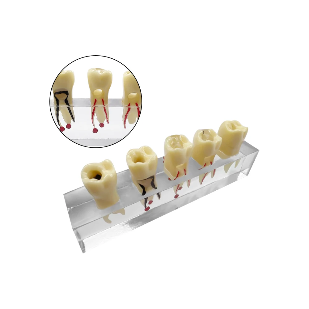 

Transparent Root Canal Practice Model Disease Teeth Model for Dental Technician Endodontic Treatment Studying Teaching Models