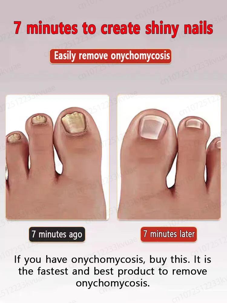 

Remove onychomycosis and make your nails look brand new