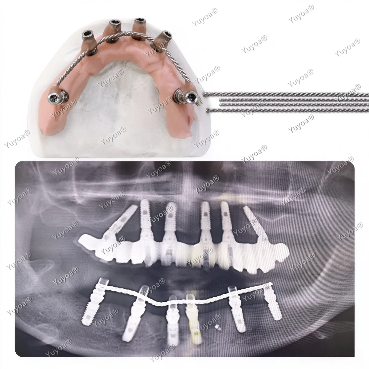 30Pcs/box Dental Implant Connector Stainless Wire for Overdenture MU Impant Wire Can Be Welded or Bonded MU Wire Strengthener
