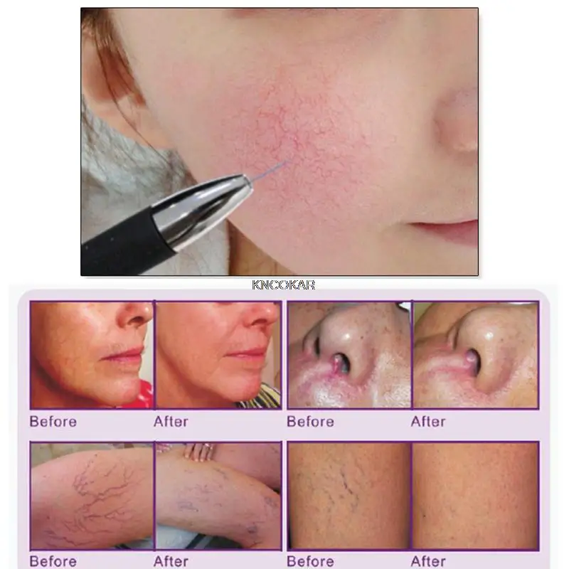 ใหม่สีแดงเลือดจุดหลอดเลือดกําจัดอุปกรณ์ความงามความถี่สูง Spider Veins Removal Anti Redness เครื่อง