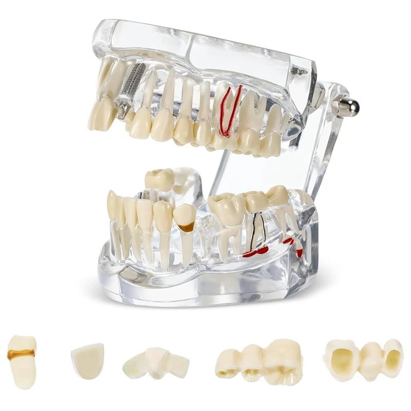

Модель зубных имплантов от типонтов со стандартной демонстрацией зубных протезов