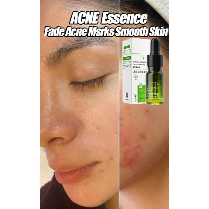 

Acne Removal Comfortable Acne-removing Liquid Improve Acne Convenient Facial Repair Solution Skin Care Pore Shrinking Gentle