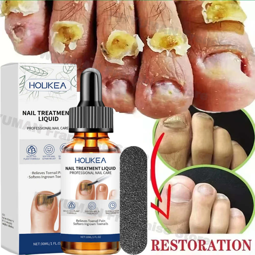 Nail Fungus Treatment Serum Treatment Toe Nails Fungal Removal Essential Oil Anti Infection Paronychia Onychomycosis Health Care