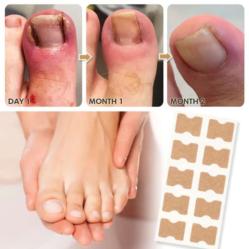 Ingrown Toenail Correction Sticker Adhesive Toenail Patch Elastic Nail Treatment Corrector Sticker Foot Care Tools