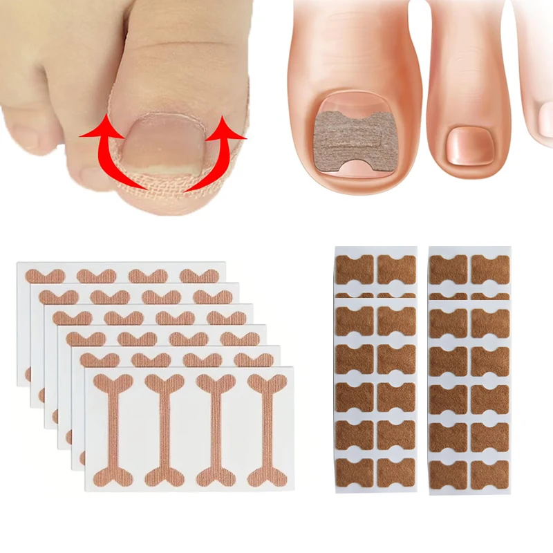 Adesivos de correção de unhas encravadas, corretor de unhas encravadas, tratamento de paroníquia, corretor de recuperação, ferramentas de pedicure