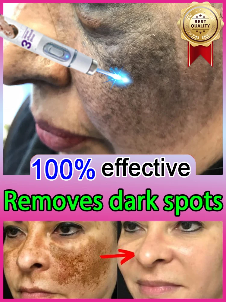 

No melasma on the face