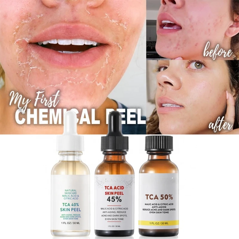 

TCA 50% Chemical Peel Tca Peel Acid Peeling Acid Skin Superforce Peeling Pigmentation Acne Scar Brighten Skin