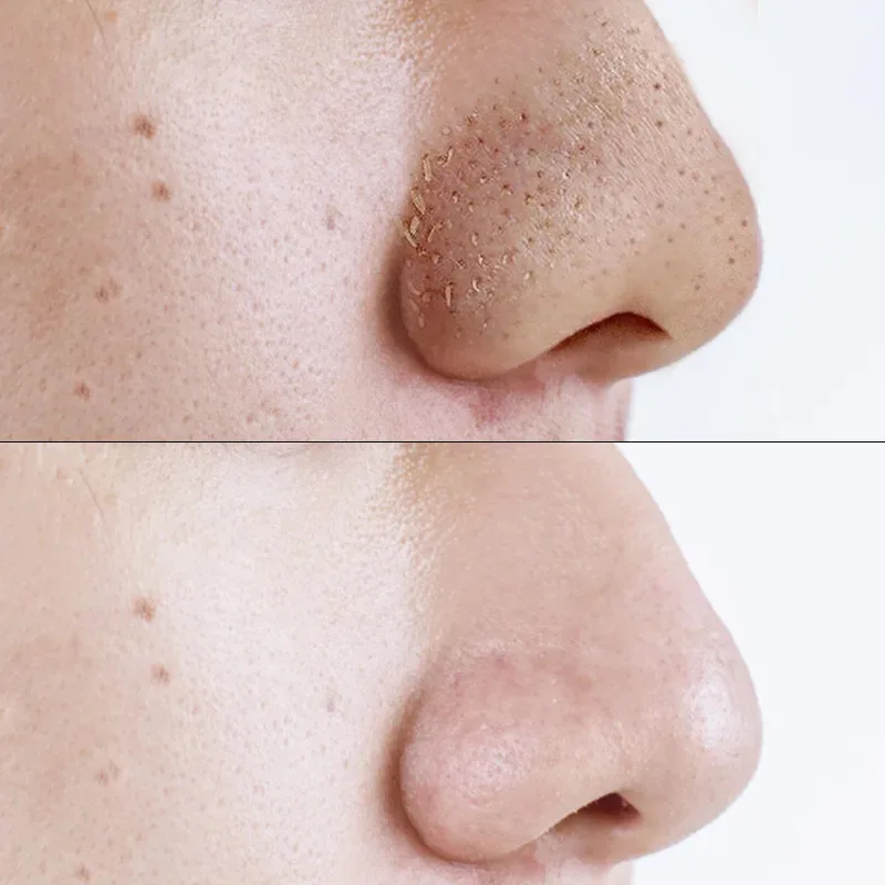 5/30pcs Nose Blackhead Remover Mask Deep Cleansing Skin Care Shrink Pore Acne Treatment Mask Nose Black dots Pore Clean Strips