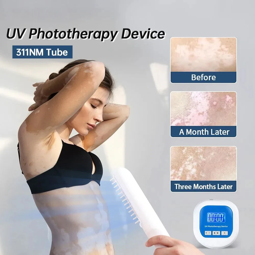 

UV 311nm Ultraviolet Phototherapy Device Uses Lamp UVB To Treat Vitiligo, Psoriasis, White Spots And Skin Diseases