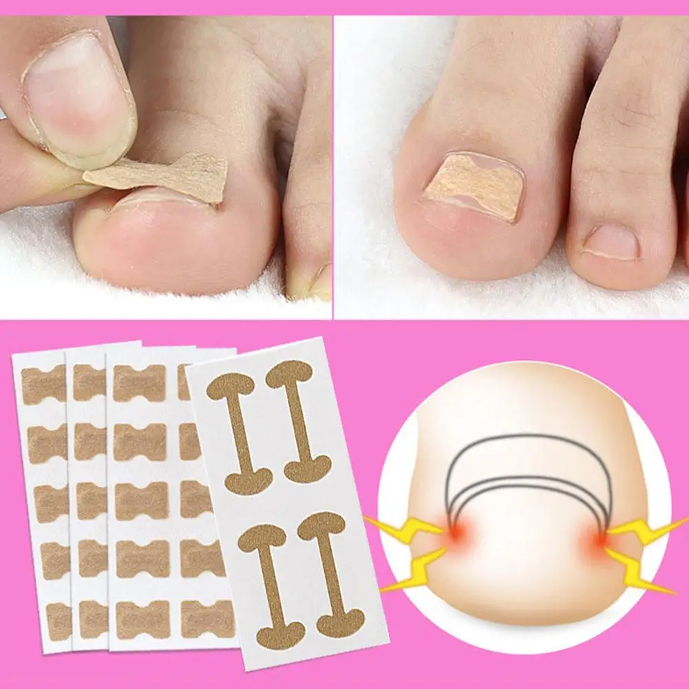 Ingrown Toenail Corrector Set with Correction Strips Toe Nail Clipper File Lifter Foot Care Tools Nail Treatment Foot Care